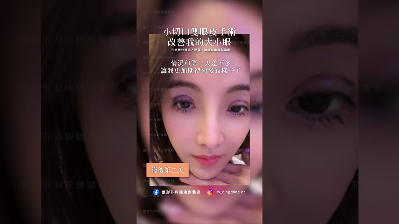 雙眼皮重修- 心湛美學診所｜專業醫美整形服務｜天鵝頸、眼袋提眉及隆乳手術, image size:1280x720