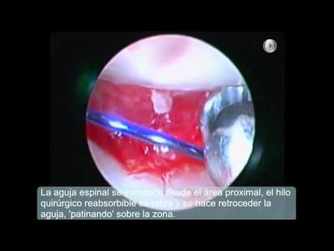 La de ligamento muñeca tratamiento desgarro del de