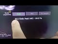 2D Speckle Tracking Strain of RV post Fibrinolytic Acute Pulmonary Embolism ( 4 days later )