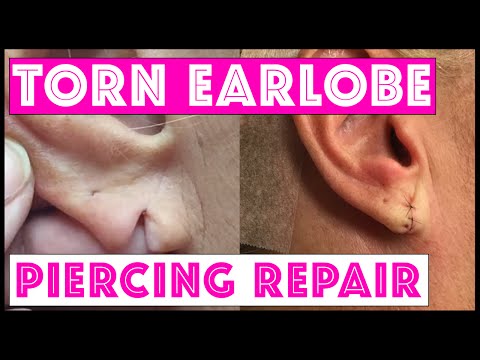 Surgical Repair Of A Torn Earlobe