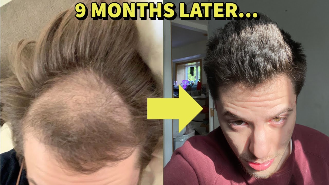 HE RESURRECTED HIS HAIR BACK FROM THE DEAD USING THESE 2 HAIR LOSS  TREATMENTS! - YouTube