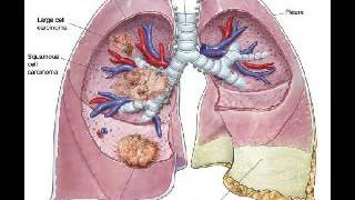 Asbestos cancer 15456