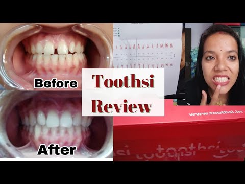 Toothsy Review Of #toothsialigners |Treatment|Cost|Benifit|Final Result ...