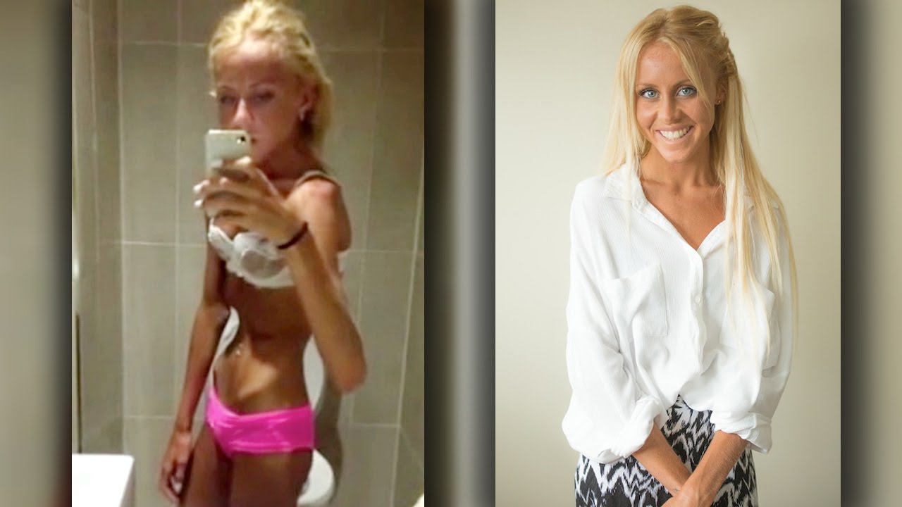 battling anorexia, recovering anorexic, anorexia extrema, extreme anorexic,...