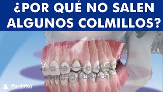 CANINOS INCLUIDOS: ¿por qué no salen los colmillos? -  Tracción con ortodoncia ©