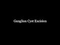 GANGLION CYST SURGERY