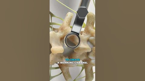 How surgeons relieve herniated disc pain (3D Animation)