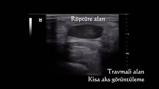 Tendon Yaralanmasında Acil Ultrasonografi