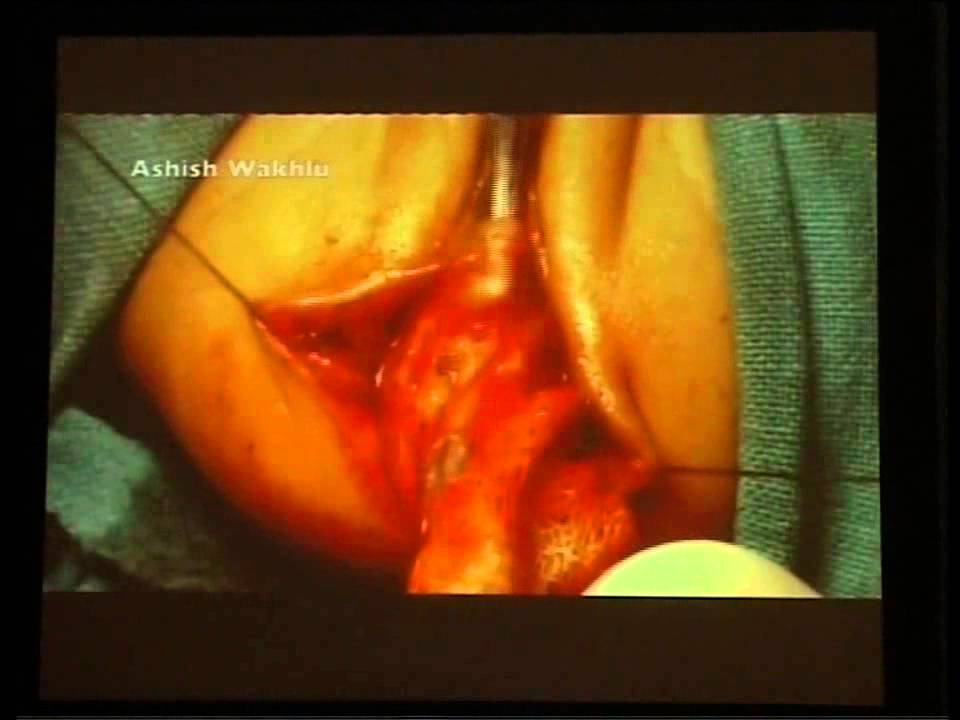 ASARP in low anal anomalies in female children