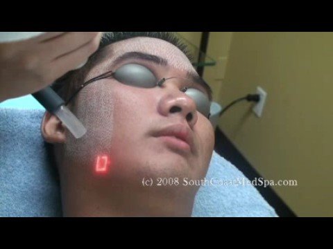 Laser Acne Scar Removal- Filipino, Male