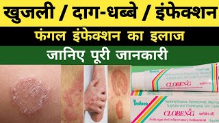 Cloben-G Cream Review Fungal, Itching, Redness Ke Liye Sahi Hai Ya Nahi?