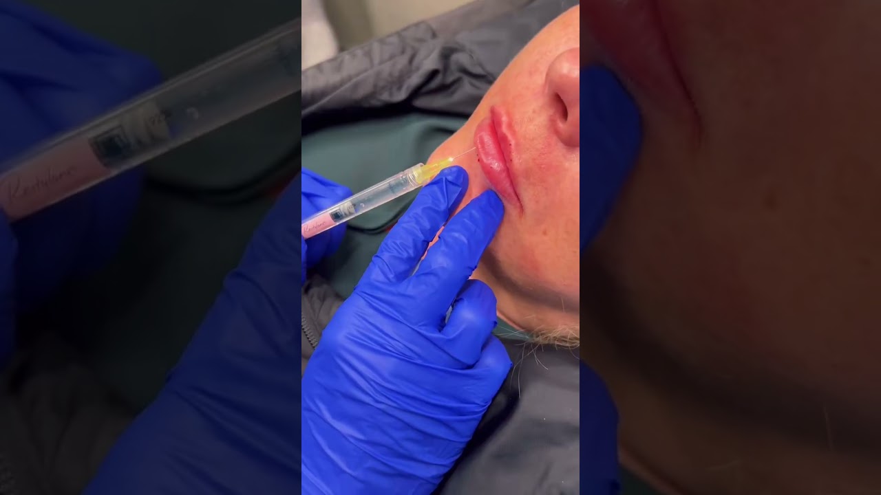 Adding vertical height with lip filler 💋