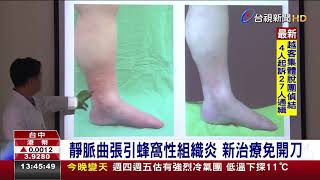 靜脈曲張引蜂窩性組織炎新治療免開刀