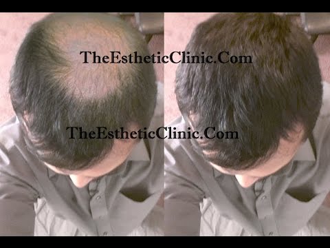 male-pattern-alopecia-treatment-|-best-treatment-for-hair-loss-&-baldness-in-india