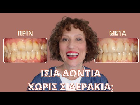 Ίσια δόντια, με