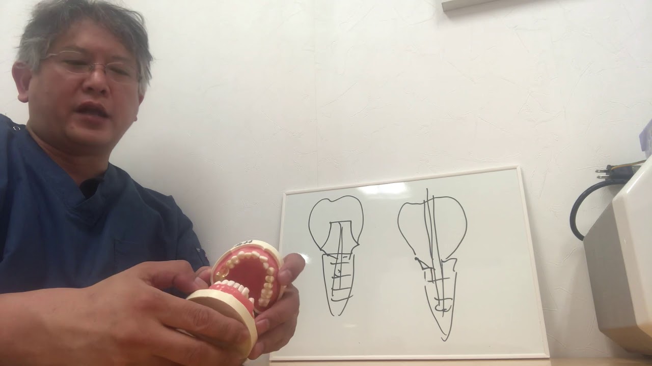 インプラント　セメントかスクリューか？