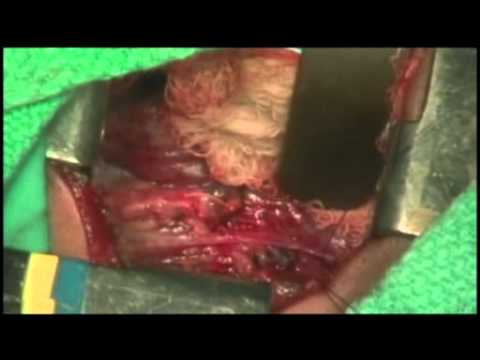 Esophageal Atresia Surgery