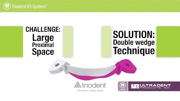 Triodent V3 System: Double Wedge technique