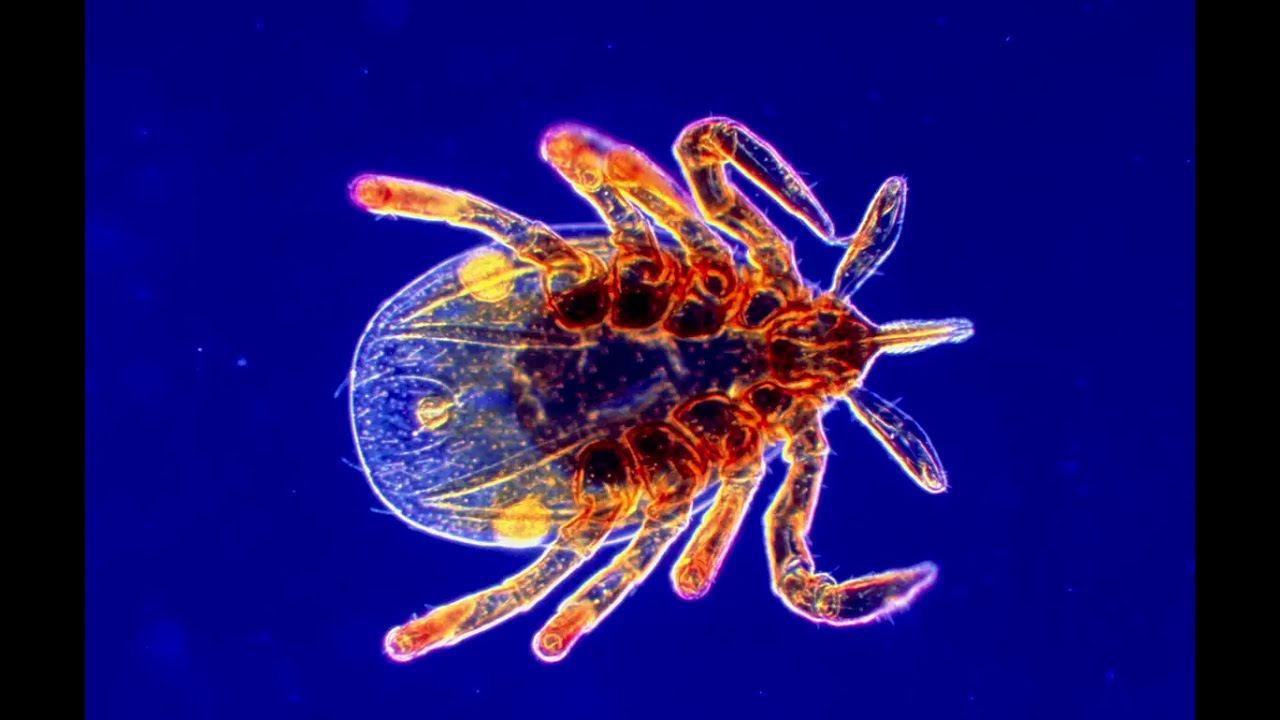 Lyme Disease A Reversible Dementia YouTube