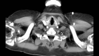DETAILED CT Anatomy Mediastinum discussion by Radiologist Middle Mediastinal Disorders Chest Radiology Essentials