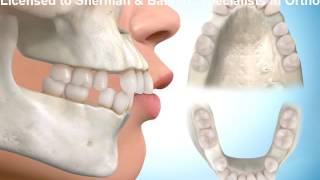 Four bicuspid Extraction Upper 1st Lower 2nd