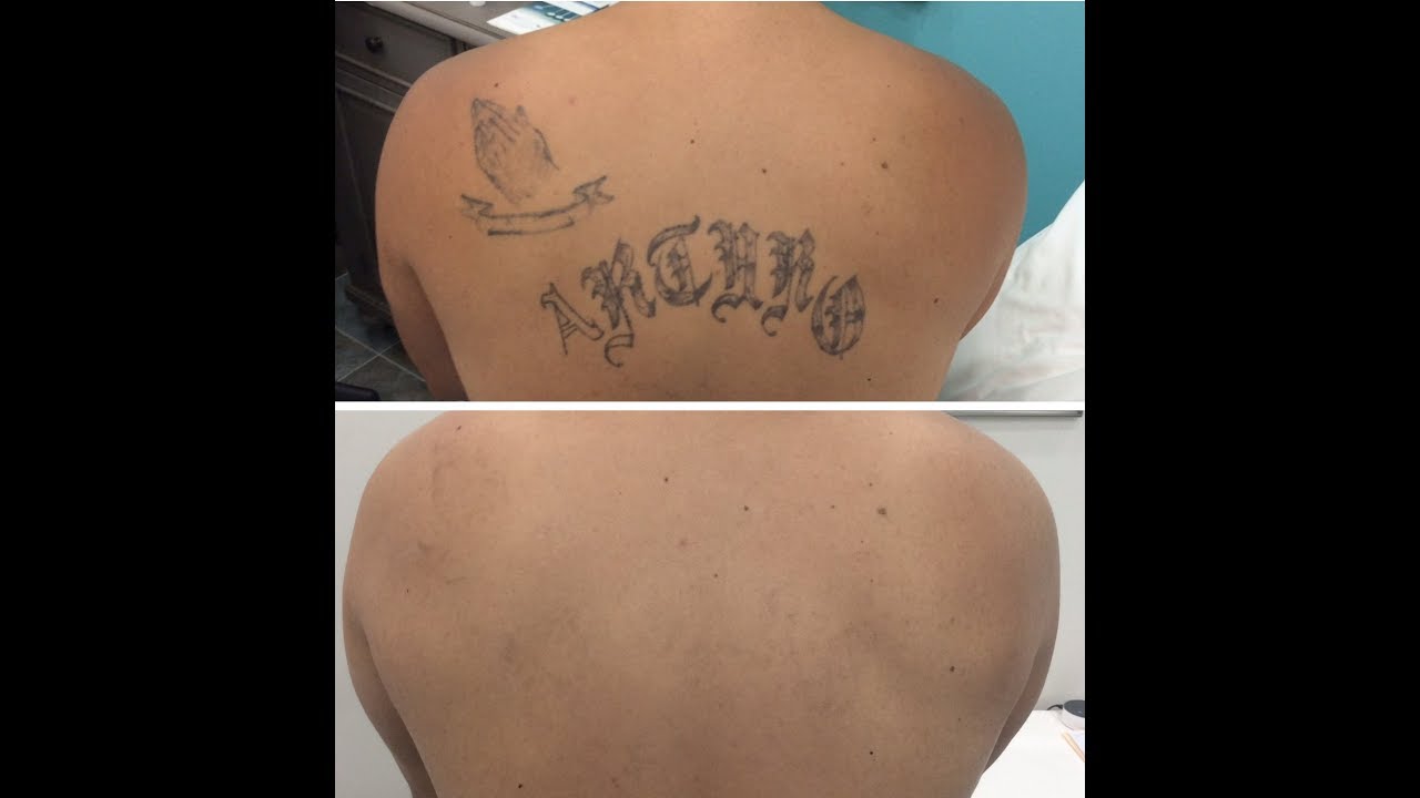 Munster, Indiana Laser Tattoo Removal Clinic Overview