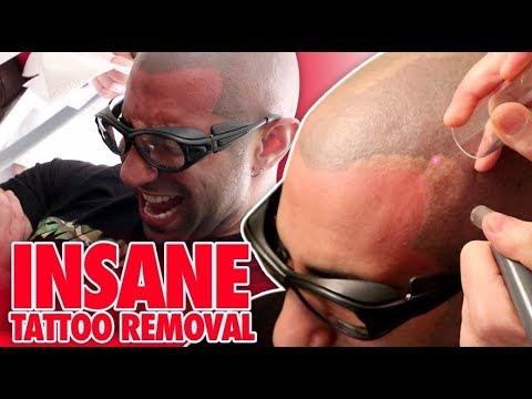 Vlogger Regrets Male Hair Loss Scalp Tattoos and Films Removal