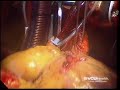 Coronary Artery Bypass Grafting