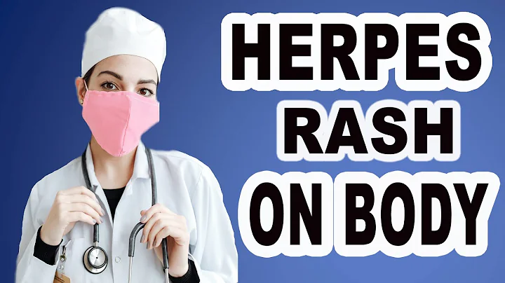 Herpes Rash On Body