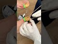 Uncover The Surgery Witness Ingrown Toenail Removal On Both Big Toes Live Procedure Footage 