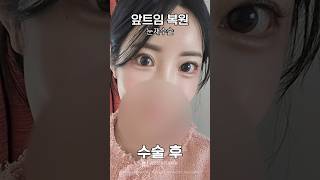 앞트임 복원 후기💖👀 앞트임 복원 + 눈재수술 #shorts
