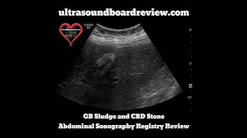 Gallbladder Stone Ultrasound