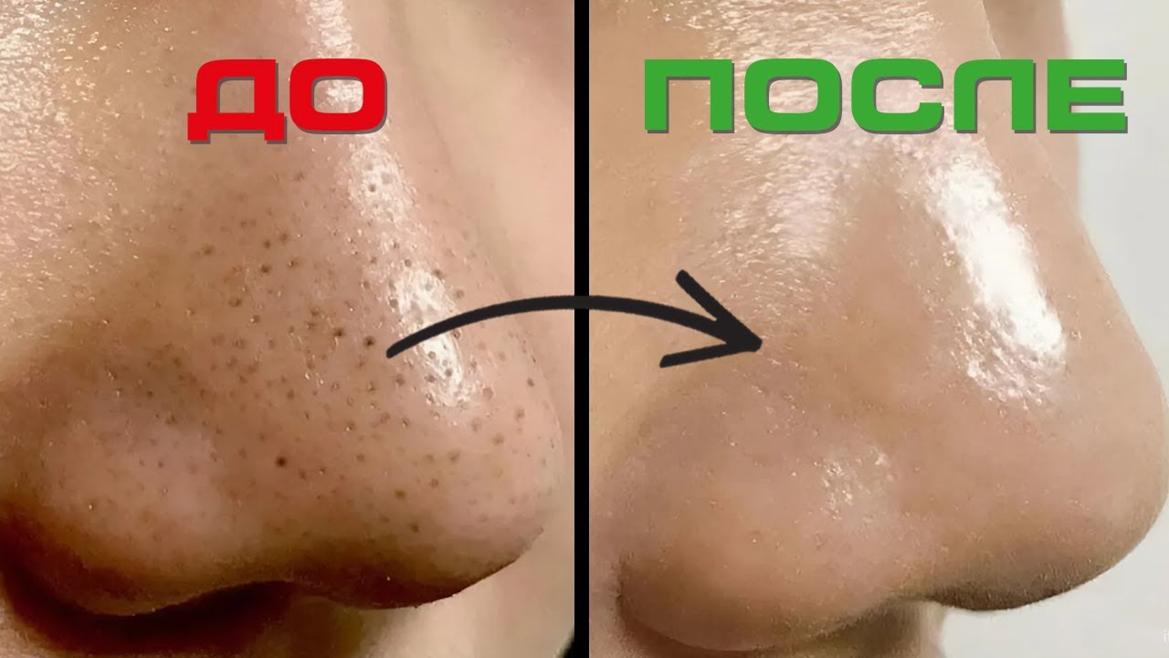 Как убрать ЧЕРНЫЕ ТОЧКИ без ВРЕДА для кожи? Ошибки, которые разрушают ваше лицо!