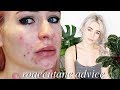 THE BEST ADVICE FOR STARTING ROACCUTANE (Top 11 Tips)