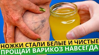 МОЩНЫЙ УБИЙЦА ВАРИКОЗА И СОСУДИСТЫХ ЗВЕЗДОЧЕК! За 15 минут в день Ножки СТАЛИ ЛЕГКИЕ И ЧИСТЫЕ!