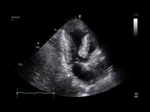 Vídeo: Infarto Septal: Definición, Síntomas Y Tratamientos