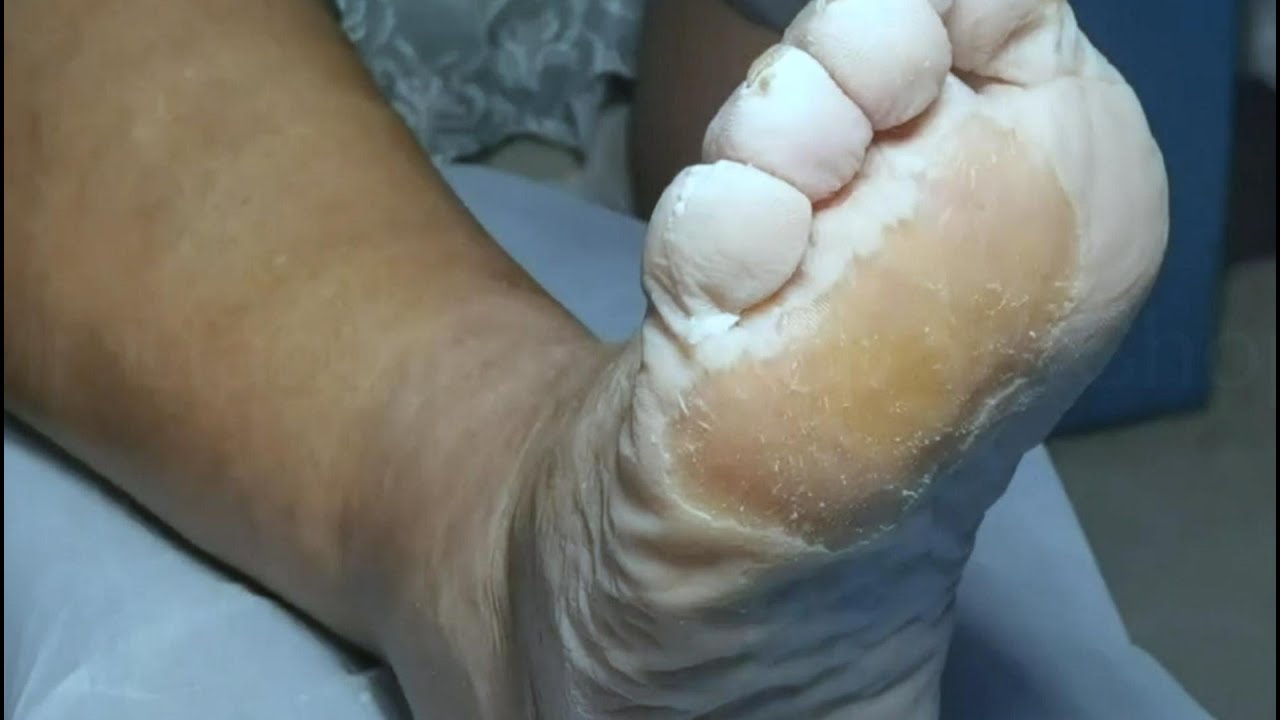 How To Remove Thick Dead Skin From Feet – Love, Lori