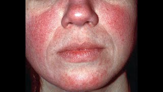 ROSACEA: Everything you need to know: Treatment-Causes- What is Rosacea?-Tips-Symptoms