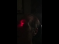Balloon Sinus Dilation in the Office