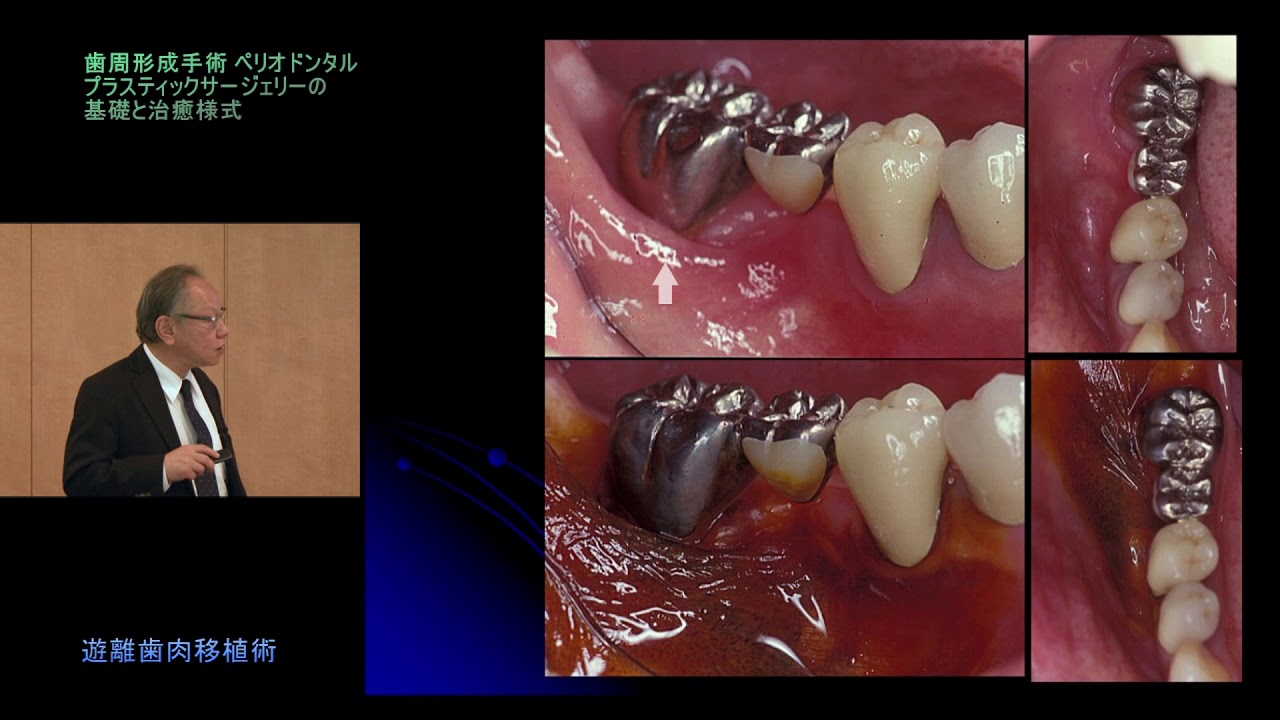 プラスティックサージェリーを究める 歯周形成手術の基礎と治癒様式 Youtube