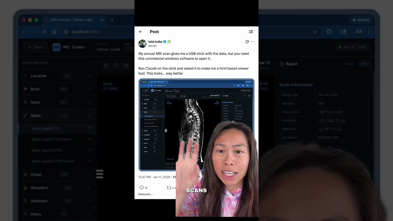 Shopify CEO Used Claude to Build a Spinal MRI Viewer in Minutes