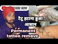   permanent tattoo removal treatmentkhanna health care clinicviralviral.s
