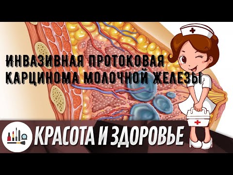 Инвазивная протоковая карцинома молочной железы