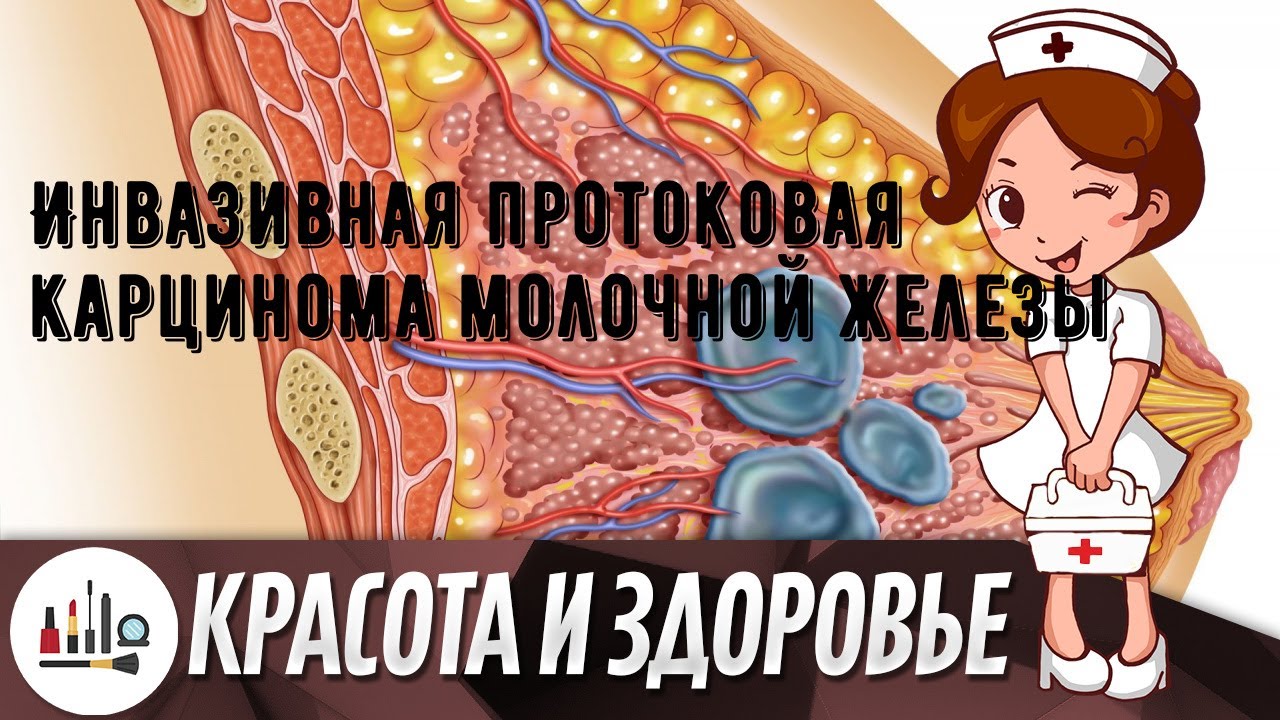 Инвазивная протоковая карцинома молочной железы