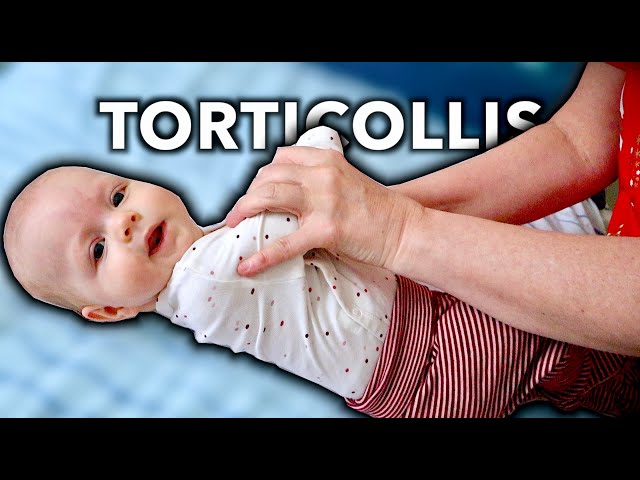 4 MONTH OLD WITH TORTICOLLIS (Treated By Massage Therapist) class=