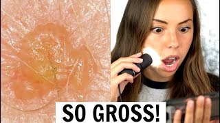 How My Acne Looks Under A Microscope! (GROSS)