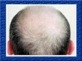 Трихологія,  лікування випадіння волосся