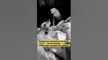 BLADELESS KNEE REPLACEMENT SURGERY USING ADVANCED ROBOTIC BURRING TECHNOLOGY! #kneepain#ai#reel#robo