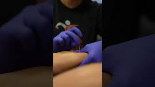 Dry Needling Tight Shins, Calves & Traps for a Runner