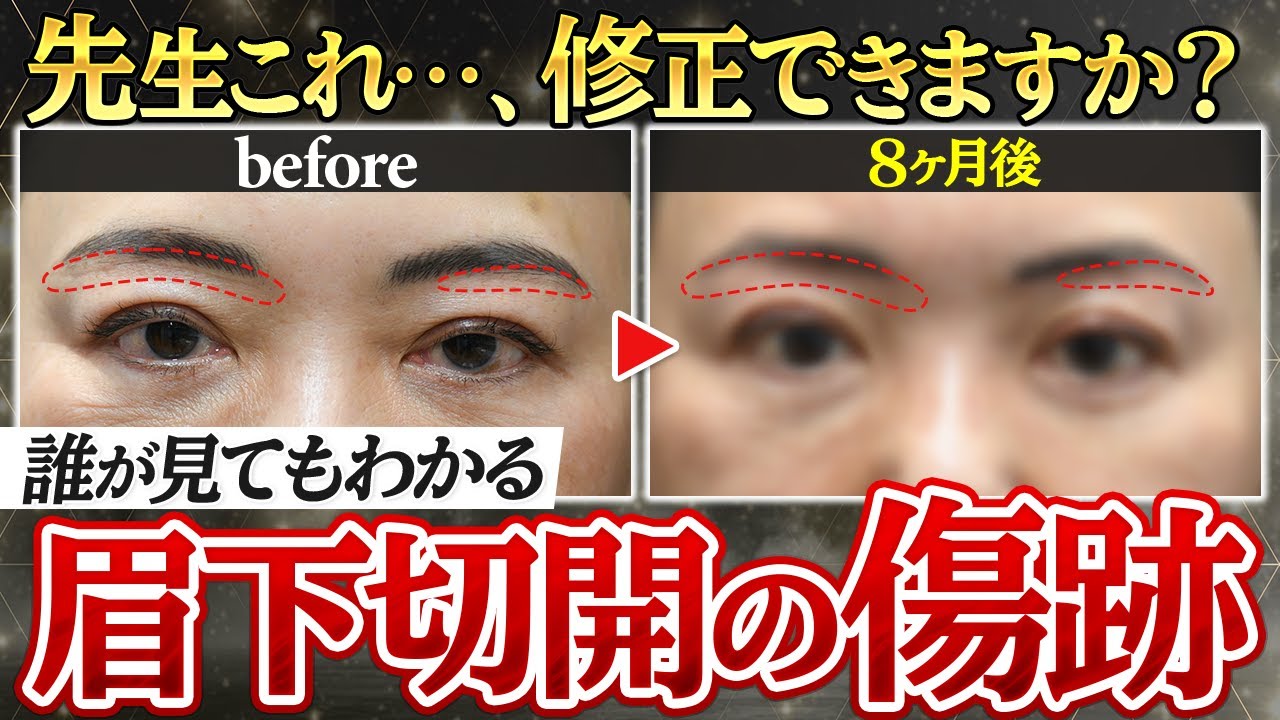 Second sub-brow incision] Are you regretting the scars? We'll show